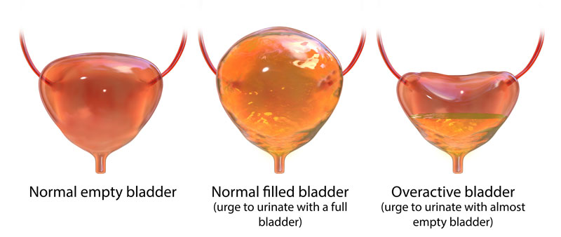 You are currently viewing Help and Tips for Patients with an Overactive Bladder
