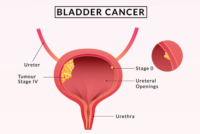 You are currently viewing May is Bladder Cancer Awareness Month