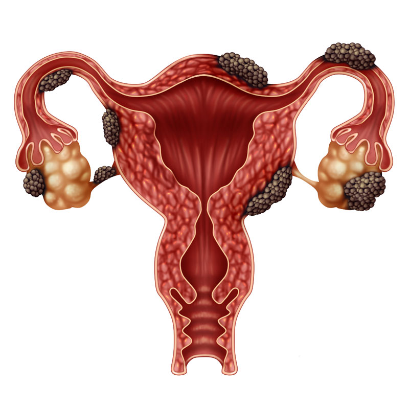 Read more about the article Can Endometriosis Cause Infertility?