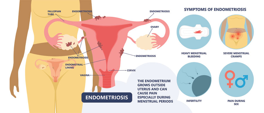 Can Endometriosis Cause Infertility