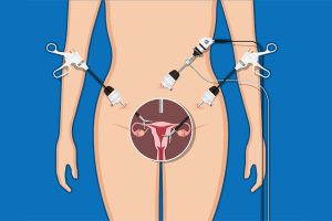 Read more about the article What Should I Know about Laparoscopy for Endometriosis