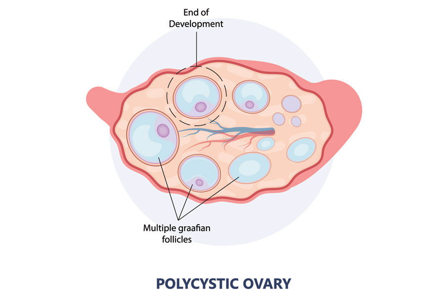 pcos polycystic