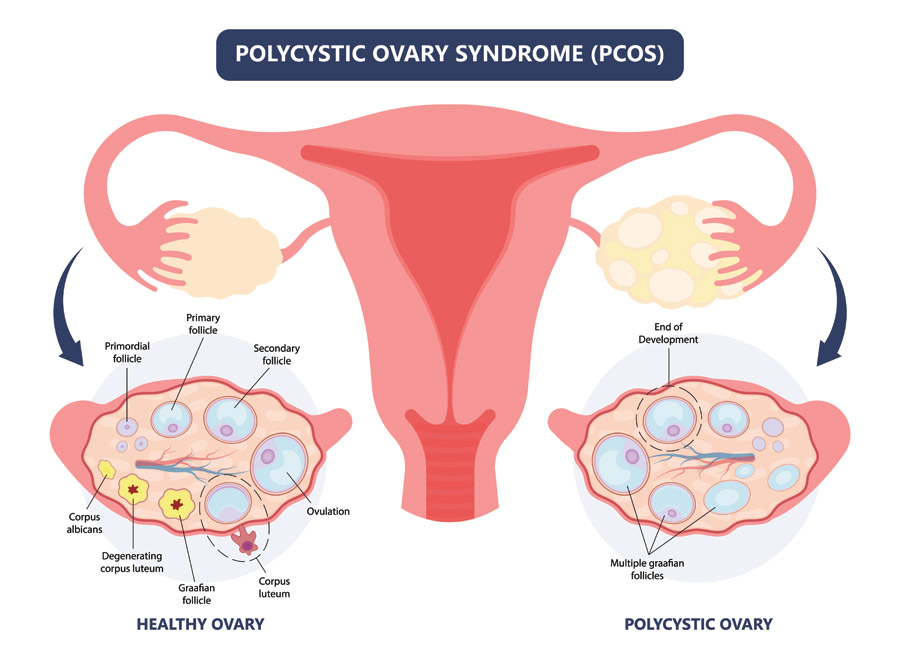 Read more about the article Can Polycystic Ovaries Make You Feel Sick? Explaining the Details