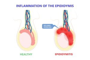 Read more about the article Inflammation of the epididymis