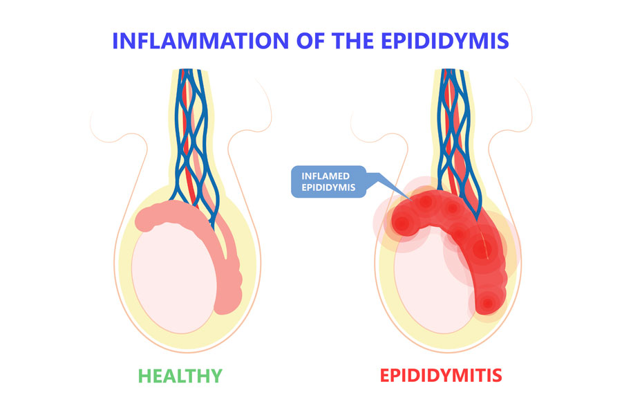 Inflammation of the epididymis