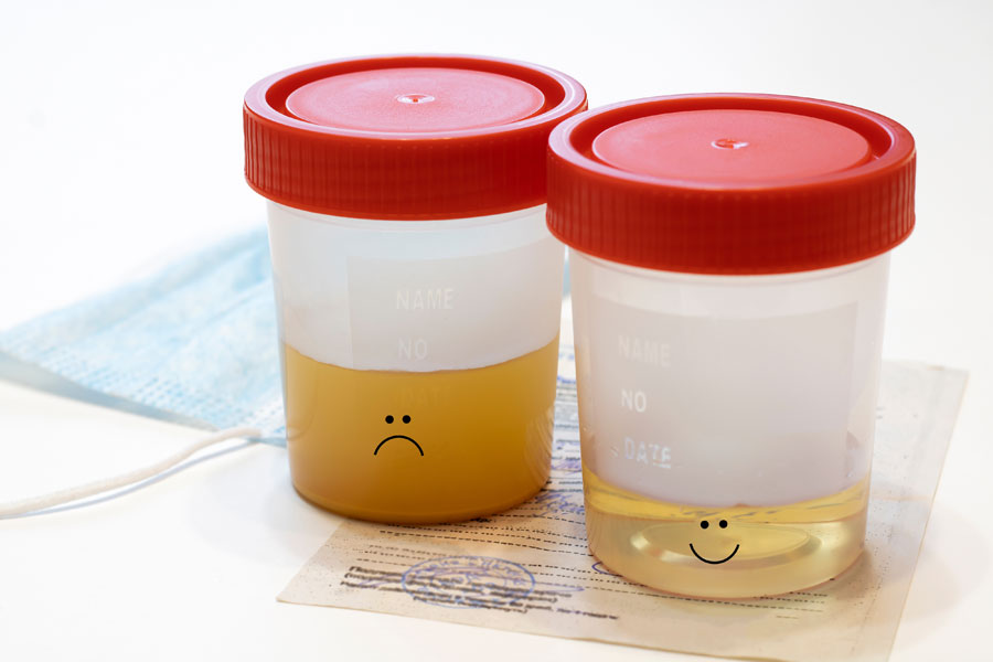 Read more about the article What does the fat in urine look like?